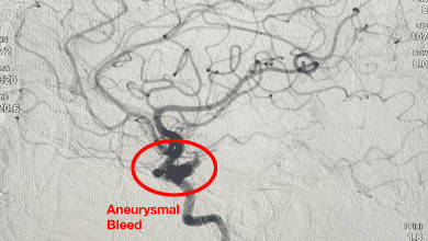 निखिल हॉस्पिटल्स: सफल एन्यूरिज्मल कॉइलिंग का उदाहरण