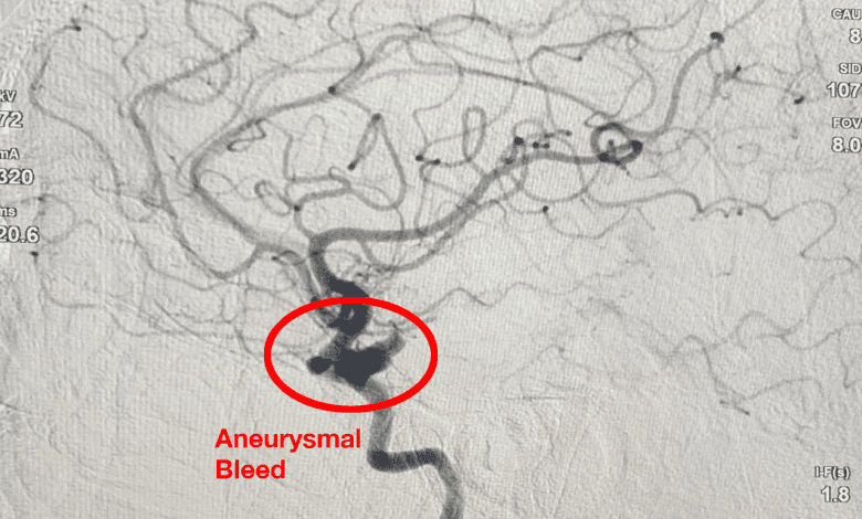 निखिल हॉस्पिटल्स: सफल एन्यूरिज्मल कॉइलिंग का उदाहरण