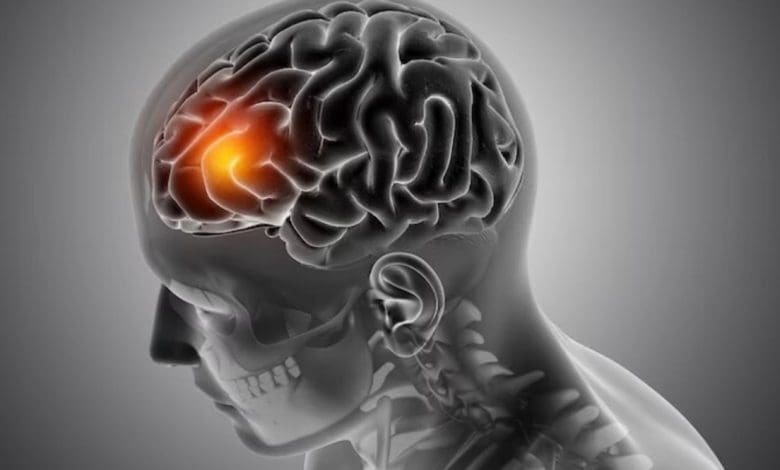 विश्व ब्रेन ट्यूमर दिवस पर ब्रेन ट्यूमर के लक्षण और बचाव