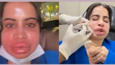 लिप फिलर्स हटवाने के बाद सूजे चेहरे के साथ उर्फी जावेद