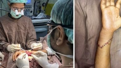 जयपुर में डॉक्टरों द्वारा बच्चे के कटे हाथ की सफल सर्जरी