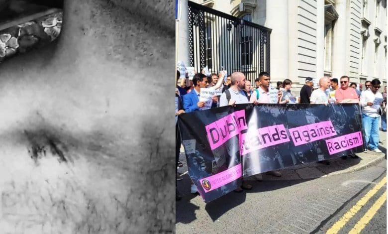 भारतीयों पर दुनियाभर में बढ़ते नस्लवादी हमले